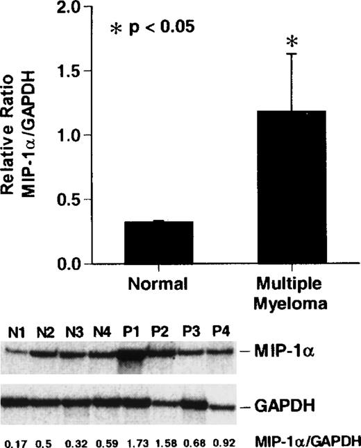 Fig. 4. Reverse transcription-polymerase chain reaction (RT-PCR) analysis of MIP-1 mRNA expression in patients with MM. / . Cycle-dependent RT-PCR was performed for 16, 20, or 24 cycles (lanes 1, 2, and 3) as described in “Materials and methods.” Results represent the mean ± SEM for 3 determinations for each patient. MIP-1α mRNA expression in patients with stage III MM was increased approximately 2- to 5-fold compared to controls in 3 of 4 patients with MM. A similar pattern of results was seen in 2 independent experiments.