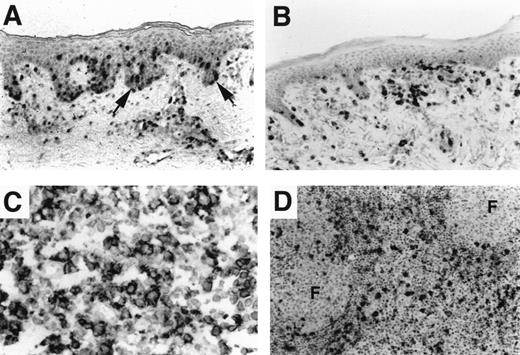 Fig. 3. Chemokine receptor expression in cutaneous lymphoma. / (A) Patch-stage MF with an epidermotropic and superficial dermal infiltrate showing CXCR3 reactivity. CCR4 immunostain was negative (not shown). (B) Cutaneous lymphoma with slack skin presentation shows reactivity of the large epidermotropic tumor cells for CCR4. CXCR3 immunostain was negative (not shown). (C) Nodal large-cell transformation of MF. Large tumor cells show diffuse reactivity for CCR4; CXCR3 was positive only in admixed small lymphocytes (not shown). (D) Increased MCP-2 in stromal cells in lymph node involvement by MF. Interfollicular macrophages and nontumor mononuclear cells show MCP-2 expression in 4 of 4 patients with nodal involvement by low-grade MF. Increased MCP-2 was not seen in nodal involvement by transformed MF (not shown).