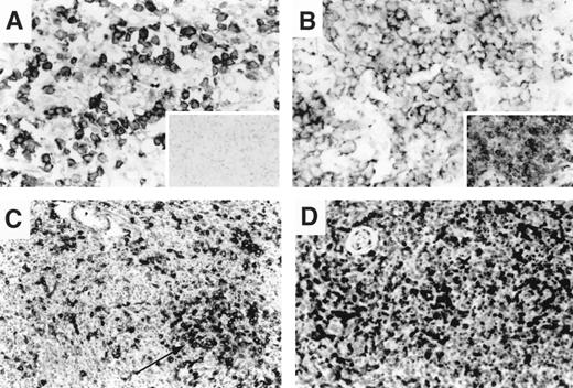 Fig. 4. Variability of chemokine receptor and TNF receptor expression in nodal T-cell lymphoma. / (A) Nodal peripheral T-cell lymphoma with a predominant large-cell morphology showing diffuse membrane and cytoplasmic reactivity for CCR4 in most tumor cells. CD30 immunostain is negative (inset). (B) Nodal peripheral T-cell lymphoma with a predominant large-cell morphology showing diffuse reactivity for CXCR3; CD134/OX40 immunostain was also diffusely positive (inset). (C, D) Angioimmunoblastic T-cell lymphoma in lymph node. CD134/OX40 immunostain highlights clusters of OX40-positive larger tumor cells (C). CXCR3 immunostain is diffusely positive in small- to intermediate-sized lymphocytes from the same biopsy (D). Large, clear cells are variably positive.