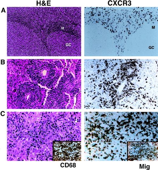 Fig. 1. Expression of the chemokine receptor CXCR3. / (A) Normal tonsil shows staining of approximately 50% of T cells in the interfollicular areas for CXCR3. B cells, in follicles and mantle zones, are negative. (B) Angiocentric T-cell lymphoma of the lung shows diffuse positivity for CXCR3 in the angioinvasive component. (C) Histiocyte-rich T-cell (lymphoepithelioid) lymphoma shows a mixture of predominantly small tumor lymphocytes and numerous CD68-positive epithelioid histiocytes (inset, left). Tumor cells are positive for CXCR3. Histiocytes show strong expression of Mig (inset, right).