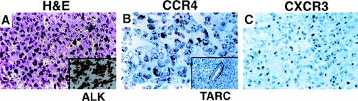 Fig. 2. Chemokine receptor expression in ALCL. / (A) Tumor shows a diffuse infiltrate of anaplastic cells with cytoplasmic and nuclear reactivity for ALK (inset). CD30 was uniformly positive (not shown). (B) Immunostain for CCR4 shows membrane and granular cytoplasmic reactivity in all tumor cells. Admixed small lymphocytes are negative. Immunostain for the CCR4 ligand TARC shows staining of intratumoral blood vessels; tumor cells are negative (inset). (C) Immunostain for CXCR3 is negative in tumor cells.