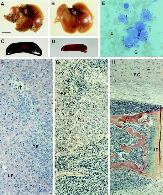 Fig. 4. Dissemination of MDAY-D2 cells and S1 transfectants to liver, spleen, and bone marrow. / Whole (A) liver and (C) spleen from mice killed 17 days after tail vein injection of control MDAY-D2 transfectants (empty vector). Multiple foci are visible in the liver, and the spleen is greatly enlarged and consists mainly of β-galactosidase–positive MDAY-D2 cells. Whole (B) liver and (D) spleen from mice injected with the S1 1.4 transfectant and killed after 17 days. No tumor cells can be detected. (E) A smear preparation of MDAY-D2 cells, stained with May-Grünwald Giemsa. Note the presence of granules (G). Histology of tissues in mice injected with control (empty vector) transfectants: (F) Liver. In the panel, LP indicates liver parenchyma; IT, intravascular tumor cells; and TF, tumor focus. (G) Spleen. RP indicates red pulp; WP, white pulp; and T, tumor cells. (H) Bone marrow. In mice injected with S1 transfected cells, the bone marrow is similarly affected, whereas the liver and spleen are tumor-free. SC indicates spinal cord; V, vertebral body; ID, intervertebral disc; and T, tumor cells. Note tumor infiltration into the spinal cord (top) and muscle (below).