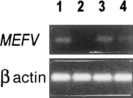 Fig. 1. MEFV expression in various cells. / RT-PCR analysis was performed on total RNA with the use of common and normal primers designed from exon 10 as described in “Materials and methods.” The size of the amplified MEFV fragment was 200 bp. Lane 1: Normal human neutrophils. Lane 2: HL-60 cells, uninduced. Lane 3: Retinoic acid–induced HL-60 cells after 5 days incubation. Lane 4: Peritoneal fibroblasts, third passage.