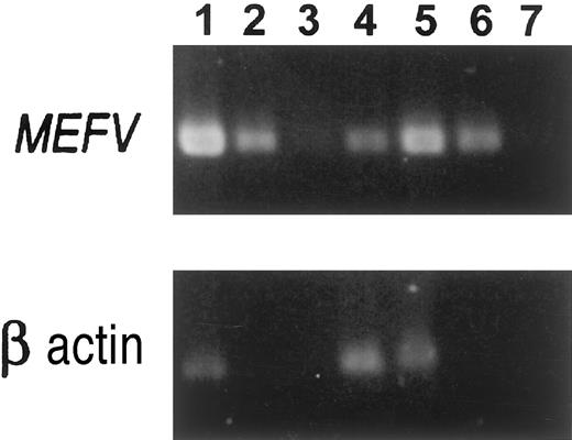 Fig. 2. Semiquantitative RT-PCR assay of MEFV expression. / RT-PCR analysis was performed with the use of primers from exons 8 and 10 as described in “Materials and methods.” The size of the amplified MEFV fragments was 420 bp. Lane 1: Normal human neutrophils; undiluted cDNA sample. Lane 2: Neutrophil cDNA diluted 1:100. Lane 3: Neutrophil cDNA diluted 1:1000. Lane 4: Normal peritoneal fibroblasts, fourth passage; undiluted sample. Lane 5: Normal peritoneal fibroblasts induced for 24 hours with 10 ng/mL IL-1β, undiluted sample. Lane 6: IL-1β–induced peritoneal fibroblasts; cDNA diluted 1:10. Lane 7: IL-1β–induced peritoneal fibroblasts; cDNA diluted 1:100. All undiluted samples included the same amount of RNA in the RT reaction.