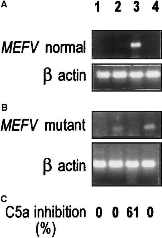 Fig. 5. MEFV expression in normal and FMF primary fibroblast cultures. / Lane 1: Normal skin fibroblasts. Lane 2: FMF skin fibroblasts. Lane 3: Normal peritoneal fibroblasts. Lane 4: FMF peritoneal fibroblasts. Three experiments were performed for each cell type, each with cells from a different passage (normal skin, passages 4, 6, 7; FMF skin, passages 1, 5, 9; normal peritoneum, passages 2, 3, 4; FMF peritoneum, passages 4, 5, 6). A representative experiment is shown in the figure. (A) RT-PCR performed with the use of the normal MEFV primer. (B) RT-PCR performed with the use of the mutant M694V MEFVprimer. Primers were designed from exon 10. (For details, see “Materials and methods” and the legend to Figure 1.) (C) Percentage of C5a inhibition. A490 readings for control C5a-induced MPO release were 0.43 to 0.58.
