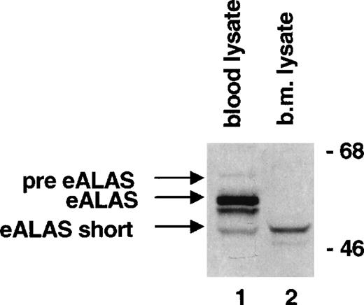 Fig. 1. eALAS protein synthesis in different erythroid tissues. / Peripheral blood and bone marrow were diluted with DMEM without methionine to 3 mL, separated on 3 mL Ficoll-Hypaque gradients, resuspended in 1 mL medium (blood, 1.5 × 108 cells; bone marrow, 1.9 × 107 cells), and incubated with 7.4 MBq (200 μCi) 35S-methionine for 3 hours. Detergent lysates were prepared, and eALAS and gel separation were immunoprecipitated. The arrows indicate the presumed pre-eALAS, the 59-kd form, and the herein described 52-kd eALAS-short.