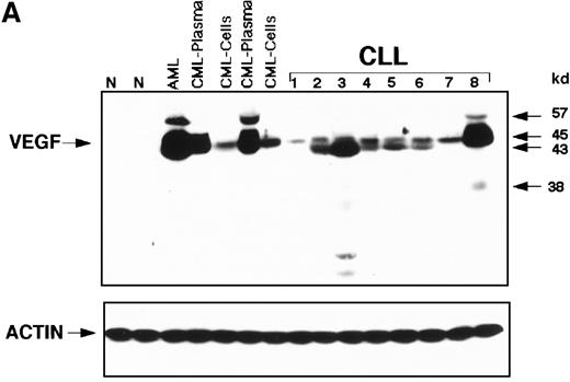 Fig. 1. Expression of VEGF protein in CLL and correlation with survival. / (A) Western blot analysis showed that the patterns of expression in most samples from patients with CLL were different from those seen in plasma and cells from patients with CML and AML. The VEGF protein expressed in CLL samples was mainly the 43-kd and 45-kd isoforms. Some samples expressed trace amounts of the 57-kd and 38-kd isoforms. (B) Patients with VEGF levels above the median had slightly better survival times (P = .07) when all patients with CLL were compared. (C) Higher levels of VEGF reflected better survival times in the subgroup of patients with low β2-M (good prognosis group). (D) High levels of VEGF correlated with better survival times in the subgroup of patients with early disease by Rai stages 0 to II.