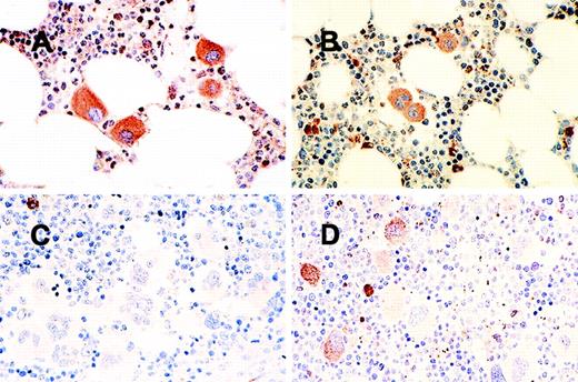 Fig. 1. Bone marrow immunohistochemical stains for megakaryocytec-mpl. / (A) Uniformly strong staining in secondary erythrocytosis; (B) uniformly moderate staining in a normal control; (C) uniformly weak staining in a patient with polycythemia vera; (D) heterogeneous staining in another patient with polycythemia vera.