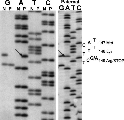 Fig. 1. DNA sequence analysis of the fibrinogen A chain exon 4. / Left panel, normal sequence (N) and sequence from the proposita (P). Right panel, sequence from the proposita's father. The novel base is shown by arrows in both panels.
