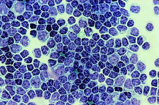 Fig. 1. Cytospin CSF preparation at diagnosis.