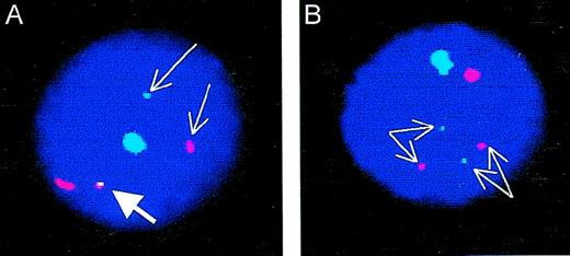 Cohybridization of sex-chromosome specific probes and BCR-ABL fusion probes. (A) BCR-ABL–positive cell male cell. Thin arrows point to the ABL (red) and BCR (green) signals; the thick arrow points to the BCR-ABL fusion. The large signals identify the X (red) and Y (green) chromosomes. (B) BCR-ABL–negative male cell. Thin arrows point to the 2 separate ABL (red) and BCR (green) signals. The large signals identify the X (red) and Y (green) chromosomes. Note that the “conventional” dual-color color FISH probe (without additional red signal on the derivative chromosome 9) was used in these experiments.