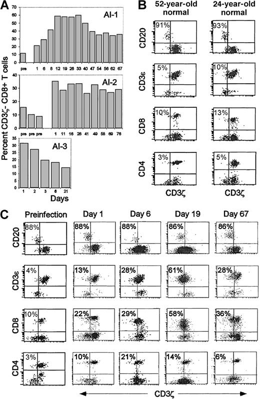 Fig. 1. Increased percentage of circulating CD3ζ− CD8 T cells in otherwise healthy subjects during acute viral infection. / (A) Three healthy donors were analyzed for CD8 T cell CD3ζ chain expression before, during, and after recovery from 3 different acute viral infections. Subject AI-1 had acute EBV infection, AI-2 had EBV–CMV– infectious mononucleosis syndrome, and AI-3 had presumed viral gastroenteritis. The percentage of CD3ζ− CD8 T cells in freshly isolated PBMC was determined by flow cytometry on gated lymphocytes using CD20+ B cells as an internal CD3ζ− population to set the CD3ζ gate. Day 1 corresponds to the onset of symptoms; day 1 samples were obtained from subjects 1 and 3 before they knew they were becoming ill. At time points before day 1, the subjects had been studied as normal controls. (B) Representative flow cytometry dot plots on gated lymphocytes, dually stained with PE-conjugated antibodies to CD20, CD3ε, CD4 or CD8, and CD3ζ− FITC, are shown for 2 normal donors. (C) Similar analysis for subject AI-1 on samples obtained either several months before the onset of symptoms or on days 1, 6, 19, and 67 after the onset of symptoms. Three-color staining with antibodies to CD3ε, CD3ζ, and CD8 in some samples (not shown) corroborated that the CD8+CD3ζ− cells are CD3ε+ T cells.
