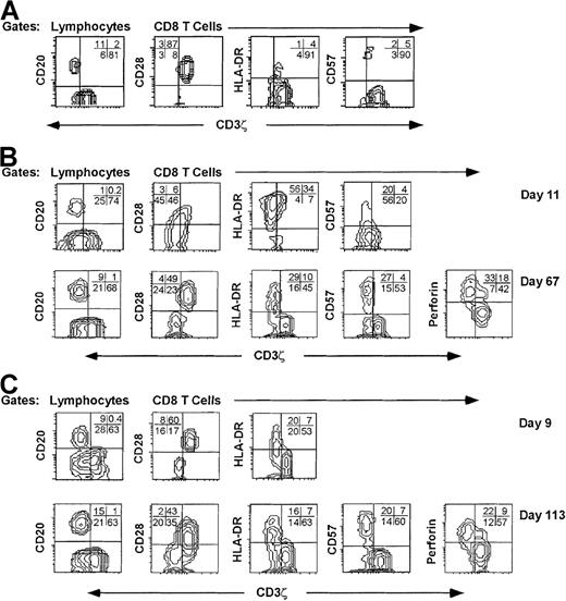 Fig. 3. CD8 T cells with down-modulated CD3ζ have an activated/effector cell phenotype. / PBMC from representative samples from a normal donor (A) and from subjects AI-1 (B) and AI-2 (C) obtained during the acute infection (days 11 and 9, respectively) and convalescence (days 67 and 113, respectively) were stained for CD3ζ and CD20 and for CD3ζ, CD8 and CD28, HLA-DR, CD57, or perforin. The CD8 contour plots were obtained by gating on CD8−Cy5 bright cells. For the normal donor, most CD8 T cells are CD3ζ+ CD28+ HLA-DR- CD57−. In acute infection samples, the CD3ζ− CD8 T cells are mostly CD28− and HLA-DR+. In convalescence samples CD3ζ down-modulated CD8 T cells are mostly CD28–, HLA-DR+, CD57+, and perforin+. Quadrants were set using CD20+ B cells (y axis) as internal negative controls for background CD3ζ staining (x axis). Similar phenotypic profiles of CD3ζ− CD8 T cells were seen in samples obtained serially throughout the illnesses (not shown).