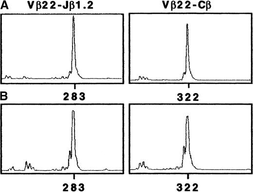 Fig. 2. Tumor T-cell line Pno and patient PBLs showed a uniqueTCR-β transcript corresponding to Vβ22/Jβ1.2. / CDR3 size analysis of TCR-Vβ22 transcripts in (A) Pno tumor cells and (B) patient PBLs were analyzed with fluorescent Cβ and Jβ1.2. We amplified cDNA made from total RNA extracted from Pno and PBLs in a PCR reaction primed by Vβ22- and Cβ-specific primers. The unlabeled amplification products were elongated with nested fluorescent Cβ and Jβ1.2. The aliquots were subjected to electrophoresis and analysis on an automated sequencer.