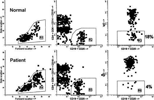Fig. 1. Flow cytometric analysis and gating of blood B cells showing the relative lack of IgD− B cells in a BMT recipient 1 year after grafting. / Both specimens, normal and patient, were processed concurrently. Ficoll-isolated mononuclear cells (MNCs) were stained with anti-IgD–FITC (goat F(ab′)2 antihuman delta chain), anti-(CD4, CD8, CD14, CD16)–PE, and anti-(CD19, CD20)–peridinin chlorophyll protein. Data were acquired on FACSCAN cytometer. For analysis, first the MNC gate (R1, R4) was drawn on the forward- versus side-scatter dot plots (left). Then, B cells were gated on the CD19/CD20 versus CD4/CD8/CD14/CD16 dot plots (R2, R5), excluding non-B cells binding anti-CD19/CD20 nonspecifically, “B cell + non-B cell” doublets, and CD20low T cells (middle). Finally, CDl9/CD20 versus IgD dot plots were created exclusively of the cells falling within the MNC gate and the B-cell gate, ie, R1 and R2 in the normal and R4 and R5 in the patient (right). To calculate the percentage of IgD− B cells, regions R3 and R6 were set so as to encompass the B cells showing only background FITC fluorescence. In this example, 18% of B cells in the normal were IgD− versus 4% of B cells in the patient.