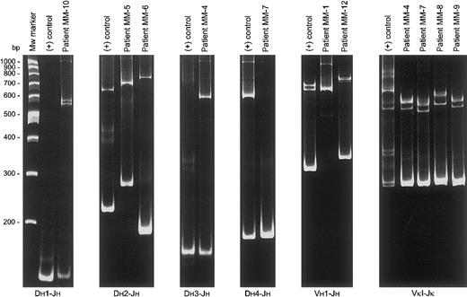 Fig. 2. Heteroduplex PCR analysis in several IgH−MM patients to distinguish between polyclonal and monoclonalIGH and IGK gene rearrangements. / Clonal homoduplexes found with particular primer combinations are illustrated as compared to positive controls. In patient MM-1, the size of the homoduplex found with the Vh1-Jh PCR was essentially larger than predicted. Sequence analysis showed a PCR product with a Vh1-24/Jh3 rearrangement extended to the Jh5 segment with extensive somatic hypermutation of the Jh3 gene (resulting in loss of the primer annealing site) and deletion of the Jh4 segment most probably owing to an abnormal somatic mutation process.48