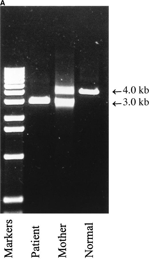Fig. 1. Molecular mass analysis of PCR products derived from amplification of genomic DNA and of mRNA species derived by reverse transcriptase PCR. / (A) PCR amplification of exons 1 to 4 of genomic DNA from patient 1, his mother, and a normal control was performed as described in “Patients, materials, and methods.” The normal product is approximately 4.0-kb, and the product derived from amplification of exons 1 and 4 with exons 2 and 3 deleted is approximately 3.0-kb. (B) RT-PCR of mRNA prepared from whole blood was performed as described in “Patients, materials, and methods.” Left lane, markers; right lanes, 5, 10 and 13 μL of PCR product. The upper band is derived from a mRNA with exons 2 and 3 skipped, the lower band is derived from a mRNA species with exons 2, 3, and 4 skipped.