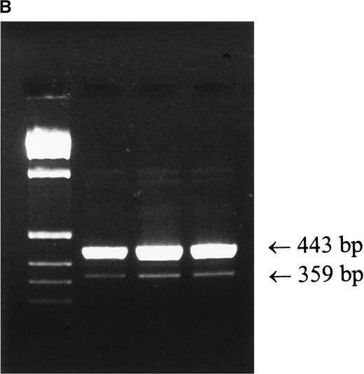 Fig. 1. Molecular mass analysis of PCR products derived from amplification of genomic DNA and of mRNA species derived by reverse transcriptase PCR. / (A) PCR amplification of exons 1 to 4 of genomic DNA from patient 1, his mother, and a normal control was performed as described in “Patients, materials, and methods.” The normal product is approximately 4.0-kb, and the product derived from amplification of exons 1 and 4 with exons 2 and 3 deleted is approximately 3.0-kb. (B) RT-PCR of mRNA prepared from whole blood was performed as described in “Patients, materials, and methods.” Left lane, markers; right lanes, 5, 10 and 13 μL of PCR product. The upper band is derived from a mRNA with exons 2 and 3 skipped, the lower band is derived from a mRNA species with exons 2, 3, and 4 skipped.