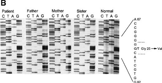 Fig. 2. Sequence analysis of exon 1 and 2 in patient 5. / Panel A: Sequence analysis of exon 1 of the CYBA gene of patient 5 and his family members. The patient, his father, and sister are all heterozygous for A at nucleotide 26, producing a nonsense codon at amino acid 9. The normal control shows only G at position 26. Panel B: Sequence analysis of exon 2 of the CYBA gene of patient 5 and his family members. The patient is homozygous for T at nucleotide 74, causing the replacement of glycine 25 with valine. The patient's mother is heterozygous as seen by the presence of both G and T at position 74. The patient's father and sister do not carry this allele as seen by the appearance of only the G at this position.