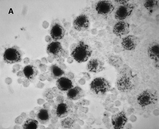 Fig. 1. Gene delivery in HC monocytes–macrophages bySalmonella carrier. / In vitro differentiated macrophages from patients with HC were infected with Salmonella harboring the pCMV-βgal plasmid. (A) βgal expression in peripheral blood mononuclear cells was restricted to macrophages (large cells) and spared lymphocytes (small cells). (B) A duplicate cell preparation of A after complement-lysis of lymphocytes showing high βgal expression in most cells.