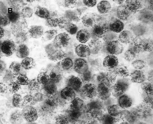 Fig. 1. Gene delivery in HC monocytes–macrophages bySalmonella carrier. / In vitro differentiated macrophages from patients with HC were infected with Salmonella harboring the pCMV-βgal plasmid. (A) βgal expression in peripheral blood mononuclear cells was restricted to macrophages (large cells) and spared lymphocytes (small cells). (B) A duplicate cell preparation of A after complement-lysis of lymphocytes showing high βgal expression in most cells.