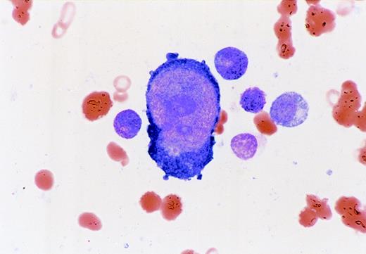 Fig. 1. A giant pronormoblast with prominent nuclear inclusion bodies dwarfs the granulocyte precursor cells. / Evaluation of the bone marrow aspirate revealed maturing granulopoiesis and thrombopoiesis but severely suppressed erythropoiesis, which was arrested at the pronormoblast stage. The myeloid:erythroid ratio was 72:1, with pronormoblasts comprising 1.2% of total bone marrow cells.