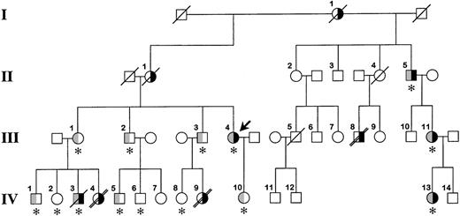 Fig. 1. Family pedigree. / The bold arrow indicates the proband. Roman numerals to the left of the figure indicate the generation, and Arabic numerals above each symbol indicate the family member. The right side of the symbol is black for family members who have experienced venous thrombosis. The left half of the symbol is gray for family members heterozygous for the fibrinogen Paris V mutation. The asterisk below the symbol indicates that DNA was available for identification of the fibrinogen Paris V mutation. A diagonal slash through the symbol indicates death, and a double slash indicates that death was from pulmonary embolism. It is possible that patient IV.3 died from a pulmonary embolus; however, this was not established during the hospital stay, and no autopsy was performed.