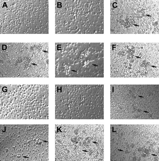 Fig. 6. Aggregation of CD34+ hematopoietic progenitors. / Aggregation induced by γIP-10 (A, D, G, and J), Mig (B, E, H, and K), or SDF-1α (C, F, I, and L) is shown. CD34+ hematopoietic progenitors from human cord blood were either freshly isolated (A-C), stimulated with GM-CSF (D-F), incubated with anti-CXCR3 mAb and stimulated with GM-CSF (G-I), or incubated with isotype mAb and stimulated with GM-CSF (J-L). Arrows indicate the aggregation clusters. The cells were photographed at ×100 magnification. Aggregation in A, B, G, and H was estimated to be 0; that in D, E, F, I, J, and L to be 2+ to 3+; and that in C and K to be 4+. The photographs are representative of 3 similar experiments.