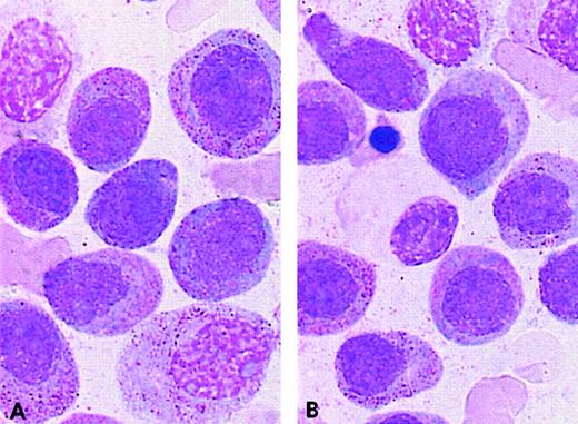 Fig. 4. PML/RARA+ cases of the ider(17) group. / The majority of blasts with (A, B) regular nuclei and (B) a Pelger-like cell.