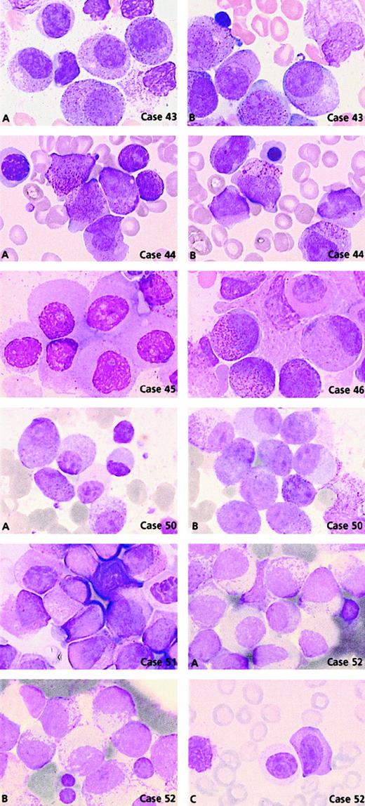 Fig. 5. PLZF/RARA cases. / Case 43: Blasts have regular nuclei with (A) hypergranular cytoplasm and (B) faggots of Auer rods. Case 44: Blasts have irregular nuclei with (A) hypergranular cytoplasm and (B) Chediak-like granules. Case 45: Blasts have regular nuclei and poorly granular cytoplasm. Case 46: Blasts with regular nuclei, basophilic granules, and a Pelger-like cell. Case 50: Blasts with regular nuclei and either (A) hypogranular or (B) hypergranular cytoplasm and (A) a Pelger-like cell. Case 51: Majority of blasts have regular nuclei and a Pelger-like cell. Case 52: Blasts with regular nuclei and either (A) hypogranular or (B) hypergranular cytoplasm with myelocyte-like features and (C) a Pelger-like cell.