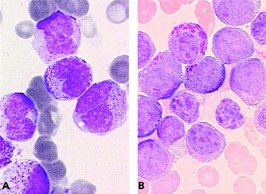 Fig. 6. Chromosome transcription t(5;17) cases. / (A) The NPM/RARA case: Majority of blasts have irregular nuclei and hypergranular cytoplasm without Auer rods. (B) The der(5)t(5;17) case: Blasts with regular nuclei, hypergranular cytoplasm with Chediak-like granules, and Pelger-like cells.