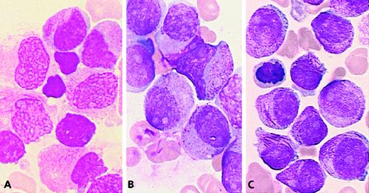 Fig. 7. Cases lacking RARA rearrangements. / (A) Case 60: The majority of blasts have irregular nuclei, hypergranular cytoplasm, and faggots. (B) Case 57: The blasts have regular nuclei and hypergranular cytoplasm. (C) Case 56: Blasts with the same nuclear features and a high number of faggots.