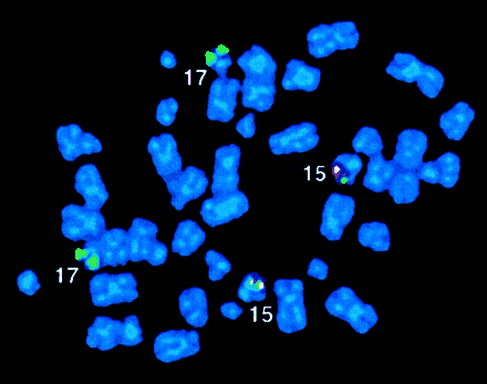 Fig. 2. FISH analysis of case 4. / The Oncor RARα and PML probes showed fusion signals on both chromosomes 15; similar results were obtained with the Vysis probe set.