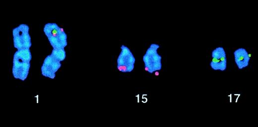 Fig. 3. Case 36 with t(1;17)(p34;q21). / FISH using ICRF PML 15.5 (red) and RARα 121 (green) cosmid probes demonstrating PML-RARα fusion signals on the der(1).
