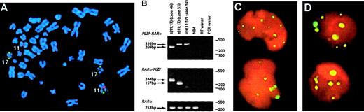 Fig. 4. Molecular analyses of. / PLZF-RARα cases. (A) Case 52 with a normal karyotype and formation of PLZF-RARα as the sole fusion gene due to an insertion event. FISH using ICRF RARα 121 (green) cosmid probe and chromosome 11 centromeric probe (red) demonstrated insertion of RARα sequences into band 11q23. (B) RT-PCR revealed expression of PLZF-RARα (3ZFPLZF breakpoint) as the sole fusion transcript in case 52, whereas both fusion transcripts were detected in cases 46 (2ZF) and 53 (3ZF). (C,D) PML immunofluorescence using the PG-M3 antibody on cytospin preparations from case 43 (C) and case 52 (D, courtesy of Francesco Fazi) showed a wild-type pattern, as distinct from the microparticulate PML staining shown in NB4 cells in Figure 8. Images were captured on a Zeiss Axioplan fluorescence microscope.