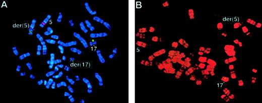 Fig. 6. FISH using ICRF. / RARα 121 cosmid probe in the t(5;17) cases. (A) Case 54: translocation of RARα sequences (green) to the der(5), identified using a chromosome 5q31 Oncor probe (red) using DAPI banding. (B) Case 55: RARα signals (green) were detected only on the normal chromosome 17. R banding using propidium iodide does not permit capture of double minute chromosomes.