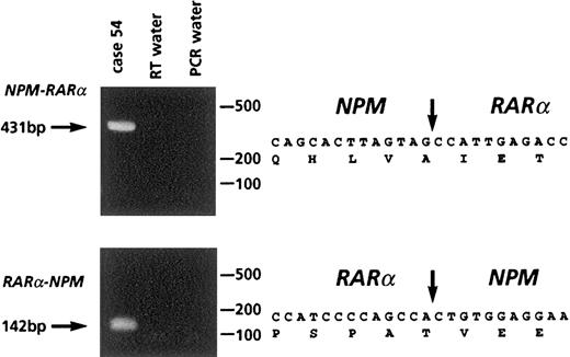 Fig. 7. Molecular analysis of case 54 with t(5;17). / Left panel: RT-PCR showing NPM-RARα and RARα-NPMtranscripts. Right panel: sequence analysis of fusion transcripts, with location of cDNA fusion junction.