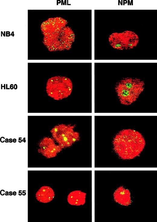 Fig. 8. PML and NPM immunofluorescence (IF) in t(5;17) cases and cell-line controls. / PML immunofluorescence using the PG-M3 antibody shows a wild-type pattern (discrete nuclear dots) in HL60 and in both patients, and a microparticulate diffuse nuclear pattern in the t(15;17) NB4 cell line. NPM immunofluorescence using the NA24 antibody shows a wild-type nucleolar pattern in both cell lines and in theNPM-RARα–negative patient (case 55), and a diffuse nuclear pattern in the NPM-RARα–positive patient (case 54). Images were captured with a Leica TCS NT confocal microscope.