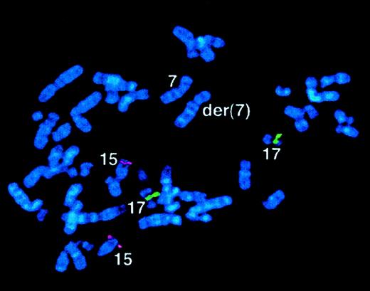 Fig. 9. Case 56 with der(7) and lacking. / RARα rearrangement. FISH using ICRFPML 15.5 (red) and RARα 121 (green) cosmid probes, demonstrating normal locations of PML andRARα sequences in the malignant clone. See text and Table6.