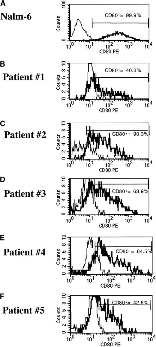 Fig. 7. pHR-GM/CD vector expression in transduced cryopreserved ALL cells. / (A) Nalm-6 reference cell line. (B-F) Cryopreserved primary ALL cells. The percentage of CD80+ cells was calculated by subtracting the transduced cells (boldface line) from the mock-transduced (thin line) control cells in the marker region.