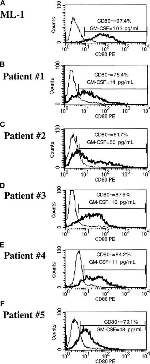 Fig. 8. pHR-GM/CD vector expression in transduced cryopreserved AML cells. / (A) ML-1 reference cell line. (B-F) Cryopreserved primary AML cells. The percentage of CD80+ cells was calculated by subtracting the transduced cells (boldface line) from the mock-transduced (thin line) control cells in the marker region.