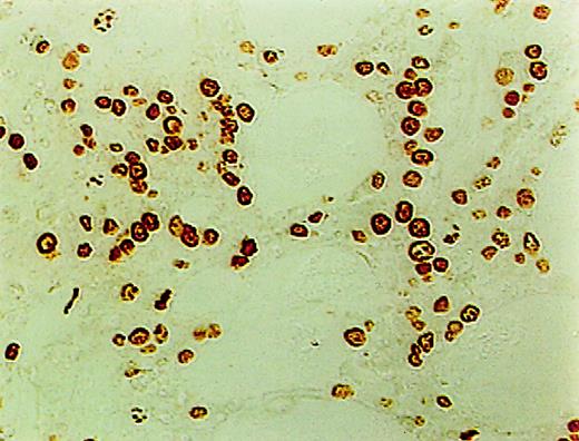 Fig. 1. High incidence of apoptosis involving hematopoietic and stromal cells in the BM of MDS patients using ISEL. / Brown staining is noted (original magnification × 400).