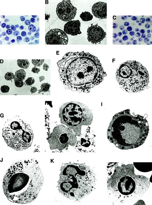 Fig. 2. Morphologically, apoptosis was seen in all the lineages, with a predominance in the myeloid and erythroid lineages. / (A) Semithin section of LDF from MDS patient showing minimal apoptosis (toluidine blue staining, original magnification × 400). (B) Electron micrograph of semithin section A (uranyl acetate and lead citrate, original magnification × 6600). (C) Semithin section of HDF from MDS patient showing increased apoptosis in the myeloid and erythroid lineage (toluidine blue staining, original magnification × 400). (D) Electron micrograph of semithin section C. Note the characteristic appearance of apoptosis, segregation of the chromatin in sharply circumscribed masses that lie against the nuclear envelope and condensed cytoplasm (uranyl acetate and lead citrate, original magnification × 6600). (E-H) Ultrastructural features of nonapoptotic cells in MDS. (E) Note the myeloblast with euchromatin nucleus, nucleoli, and a fair number of primary and secondary granules. (F) Dysplastic promyelocyte showing a low nuclear cytoplasmic ratio and abundant granules with Auer rods. (G) As the cell matures, note the characteristic Pelger-Huet anomaly showing bilobed neutrophil. (H) Polychromatophilic megaloblast with the appearance of a few clumps among the chromatin beads (uranyl citrate, original magnification × 5000). (I-L) Ultrastructural features of apoptotic cells in MDS. (I) A myeloblast showing the early stages of apotosis with only marginal condensation of nuclear chromatin, with a prominent nucleoli and preservation of the integrity of the organelles (original magnification × 8300). (J) Apoptotic promyelocyte with a perinuclear vacuole (original magnification × 6600). (K) Mature granulocytic neutrophil undergoing apoptosis, showing nuclear budding (original magnification × 8300). (L) Apoptotic erythroid cell (uranyl acetate and lead citrate, original magnification × 6600).