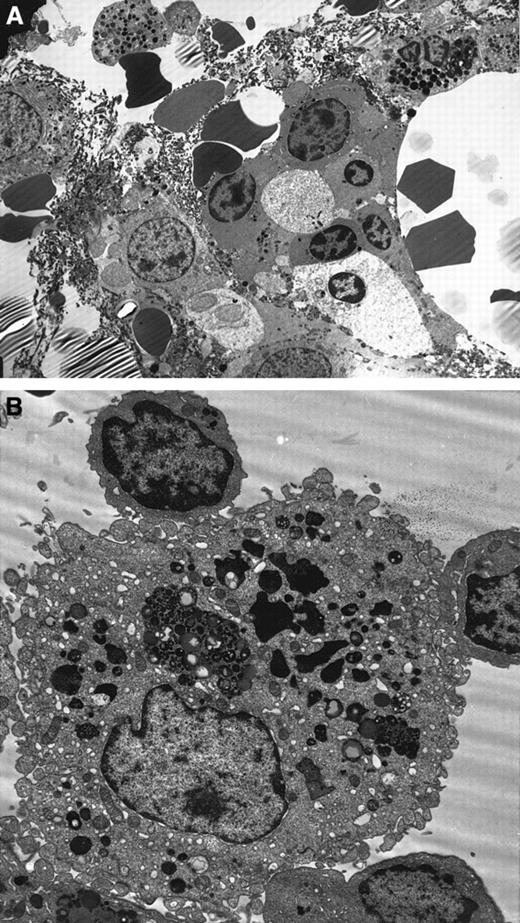 Fig. 3. Ultrastructure studies on BM biopsy. / (A) Electron micrograph of MDS BM biopsy showing apoptosis in the myeloid and erythroid lineages. Note the nuclear chromatin condensation and vacuoles in the cytoplasm (uranyl acetate and lead citrate, original magnification × 2600). (B) Macrophages showing partly degraded apoptotic erythroid cells in the lysosomes in the MDS BM biopsy (original magnification × 6600).