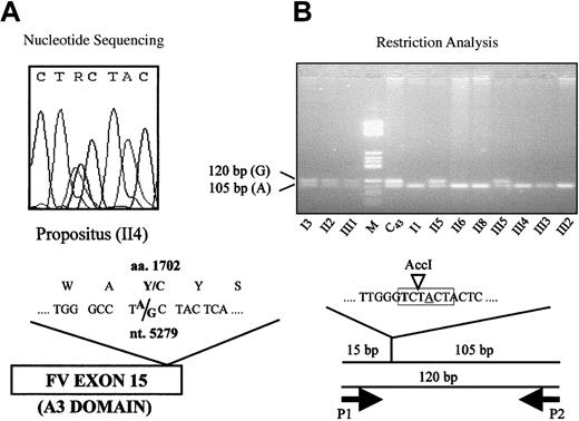 Fig. 2. Detection of the 5279A/G mutation (FV Y1702C). / (A) Detection by direct sequencing: The heterozygous sequencing pattern of the propositus is shown. The “R” in the nucleotide sequence indicates that either an A or a G may be present at this position. (B) Detection by restriction analysis: Mutagenized (bold) primer P1, which creates an AccI restriction site (highlighted in gray) in the normal (A, underlined) allele, is used in combination with reverse primer P2 to amplify a 120-bp DNA fragment. The fragments obtained byAccI digestion of the polymerase chain reaction products are visualized by agarose gel electrophoresis. C43, individual from the general population; M, molecular weight marker.