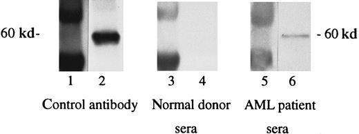 Fig. 12. Detection of WT1-specific antibodies in sera of patients with AML. / Sera of patients with AML were used in a 1:500 dilution. Lanes 1, 3, and 5 show the molecular weight marker (MWM); lanes 2, 4, and 6 show the N-terminus portion of the TRX-WT1 protein. Primary antibodies used were WT180 in lane 2, sera of a healthy donor in lane 4, and sera of a patient with AML in lane 6.