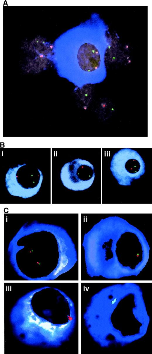 Fig. 3. Analysis of bone marrow cells. / (A) Representative cells from a myeloma bone marrow as analyzed by TRI-FISH. A normal plasma cell (blue cytoplasm) is surrounded by several nonplasma cells. Note that all nuclei contain 2 red and 2 green signals. The green signal is derived from the chromosome 10 reference probe and the red signal originates from the chromosome 13 probe D13S272. (B) TRI-FISH indicates interstitial deletion of D13S272. Cells from case 26 were hybridized with (i) D13S1150, (ii) D13S272, and (iii) AFMA301wB5 probes (red) and the chromosome 10 probe (green). Note the loss of signal for D13S272 (ii), which occurred in 22% of the light chain-restricted plasma cells. Loss of signal was not observed for the other markers. (C) Clonal heterogeneity and dispersed interstitial deletions in myeloma. Bone marrow cells from case 50 were simultaneously hybridized with probes for D13S272 (red) and D13S31 (green). Approximately 5% of the cells were normal (i), 48% of the cells demonstrated monosomy (ii), 12% of the cells showed monosomy for D13S272 and complete loss of the D13S31 signal (iii), and 23% of the cells had no signal for either probe (iv).
