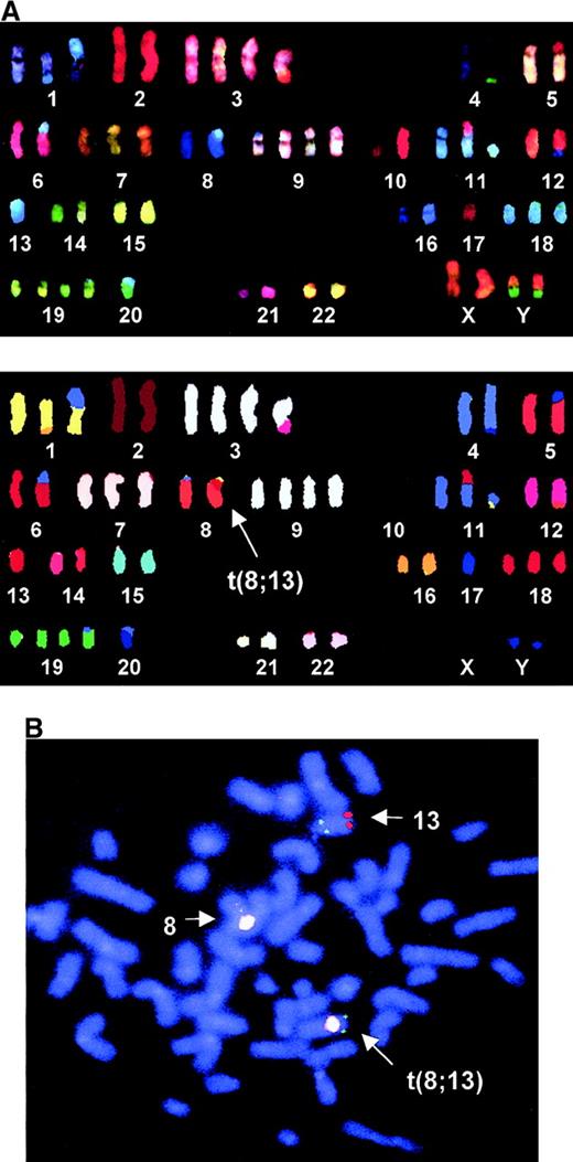 Fig. 4. Results from case 46. / (A) SKY of bone marrow chromosomes from case 46. Upper panel shows display of colors representation; lower panel shows karyotype of spectra-based classification chromosomes. Note the monosomy of chromosome 13 and the subtle t(8;13) translocation. (B) Metaphase-FISH of bone marrow chromosomes from case 46. The t(8;13) is identified by metaphase showing colocalization of D13S221 (green) and the chromosome 8 centromere-specific probe CEP8 (orange). The most centromeric marker in our panel, 13-07-5′/3′, also showed colocalization with the orange signal. Other markers along the chromosome were tested and none showed colocalization (data not shown). The normal chromosome 13 is identified by the colocalizing green and red signals. The red signal is derived from the telomeric probe D13S285. The normal chromosome 8 is identified by the single orange signal. The 2 orange signals derived from the sister chromatids are overlapping due to overexposure. All chromosomes are stained blue with DAPI.