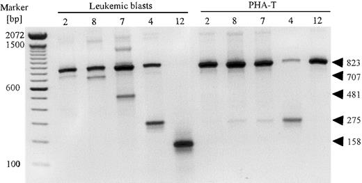 Fig. 1. A representation of the detection of dCK mRNA expression by RT-PCR analysis in leukemic blasts from patients with resistant AML. / For each sample, at least 3 PCR amplifications were performed. T7B6 dCK-PCR constructs were separated on a 1.5% agarose gel and visualized by ethidium bromide staining. Indicated are dCK-PCR constructs amplified from purified leukemic blasts from patients with resistant AML and PHA-stimulated T cells from the same individuals.