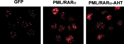 Fig. 1. Fusion protein expression in HPC/HSC. / Transduced cells were purified by FACS and analyzed by indirect immunofluorescence with α-PML monoclonal antibody,26 as described.9 In control cells (GFP), PML is expressed in a nuclear speckled distribution. Both PML/RARα and AHT mutant are expressed in the typical nuclear microspeckled pattern.